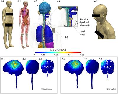 Case Report: Initial Evidence of Safety and Efficacy of High Definition-Transcranial Direct Current Stimulation in a Patient With Neuropathic Pain and Implanted Spinal Cord Stimulator